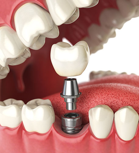 realistic illustration of a dental implant anatomy